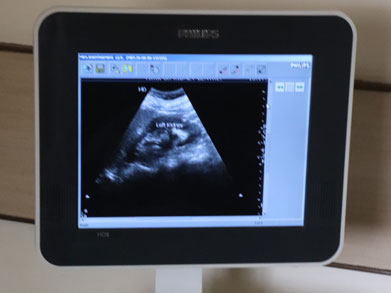 Philips hd5 ultrasound color Doppler scan